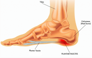 Plantar